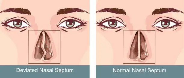 Vector illustration of Nasal Septum Deviation Treatmen