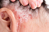 detail-der-psoriasis-hautkrankheit-psoriasis-vulgaris-in-haaren-und-ohr-mit-engen-fokus-haut.jpg?b=1&s=170x170&k=20&c=io1XMwWqlAWtYcZCQ2_WF4OYxS66GUAQP3NM6ErDDlQ=