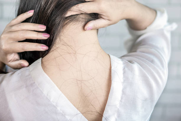 istock woman back with problem hair loss falling on neck and shoulder 1095952824