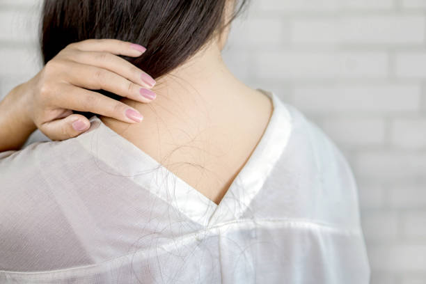 istock woman back with problem hair loss falling on neck and shoulder 1095952934