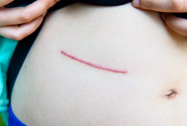 Closeup of woman showing on your stomach with a scar stock photo