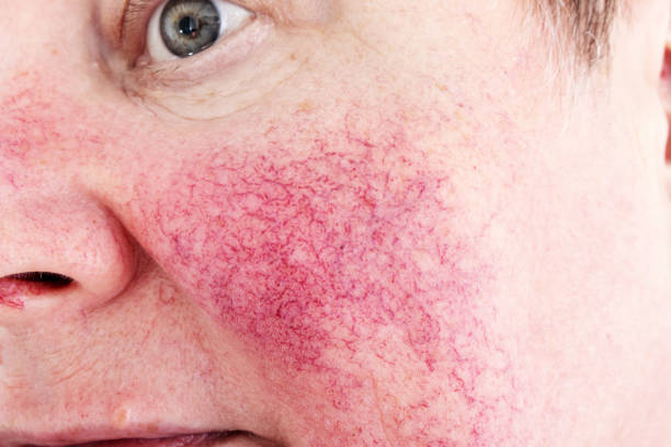 Portrait of unhappy elderly woman suffering skin disease rosacea with no make-up Portrait of unhappy elderly woman suffering skin disease rosacea with no make-up dilation stock pictures, royalty-free photos & images