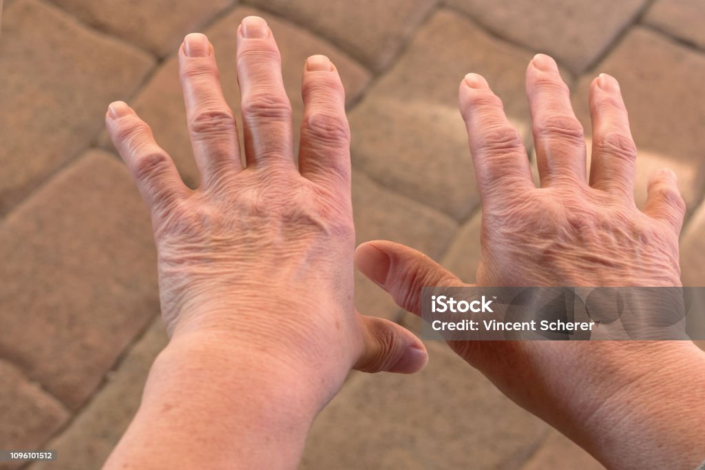 These are hands of a old woman with finger pain Adult Stock Photo