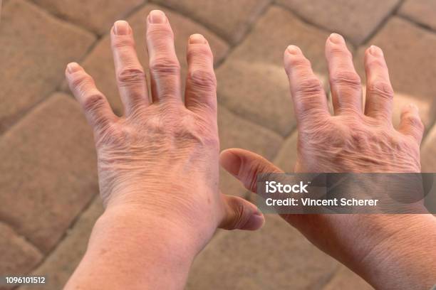 These Are Hands Of A Old Woman With Finger Pain Stock Photo - Download Image Now - Adult, Adults Only, Aging Process