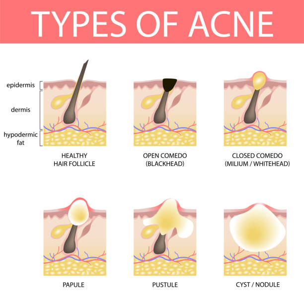 19-01-13-types-of-acne - akne stock-grafiken, -clipart, -cartoons und -symbole