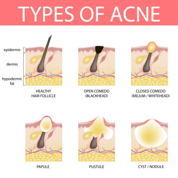 Vector illustration of 19-01-13-types-of-acne
