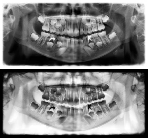 panoramic radiograph is a panoramic scanning dental x-ray of the upper and lower jaw. this is a focal plane tomography shows the maxilla and mandible of a child aged seven years. - human upper body xray imagens e fotografias de stock