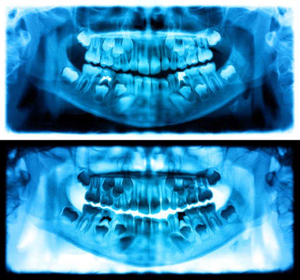 blue panoramic radiograph is a panoramic scanning dental x-ray of the upper and lower jaw. this is a focal plane tomography shows the maxilla and mandible of a child aged seven years. - human upper body xray imagens e fotografias de stock
