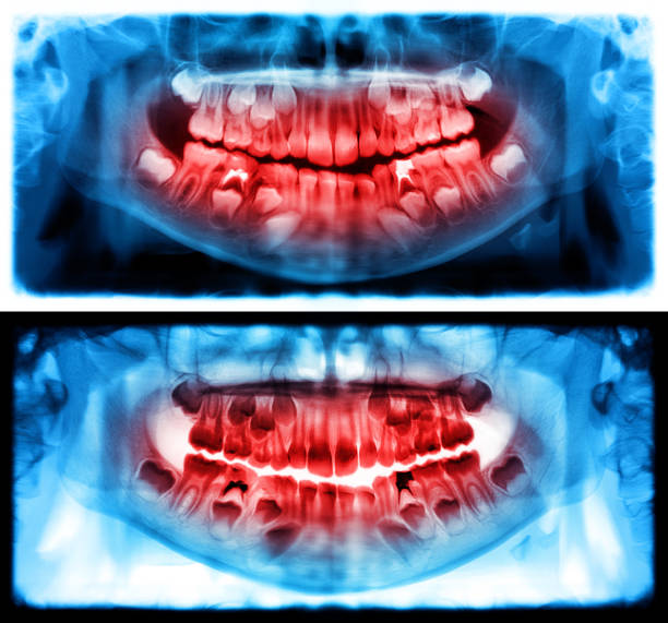 panoramic radiograph is a panoramic scanning dental x-ray of the upper and lower jaw. this is a focal plane tomography shows the maxilla and mandible of a child aged seven years. - human upper body xray imagens e fotografias de stock