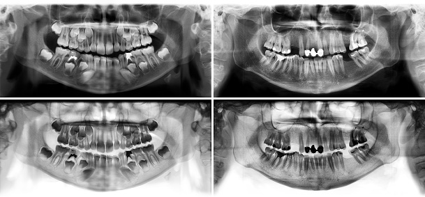 Four black and white a panoramic radiograph is a panoramic scanning dental X-ray of the upper and lower jaw. This is a focal plane tomography shows the maxilla and mandible of a child aged seven years and of a thirty seven year old man.