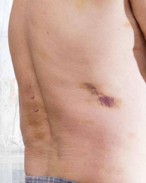 Beaten old man Hematomas on the body of an old person, on the stomach, sides, on the back bruised back stock pictures, royalty-free photos & images