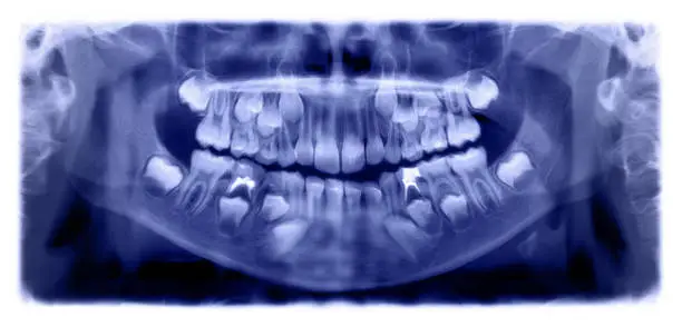 Photo of Panoramic radiograph is a panoramic scanning dental X-ray of the upper and lower jaw. This is a focal plane tomography shows the maxilla and mandible of a child aged seven years.