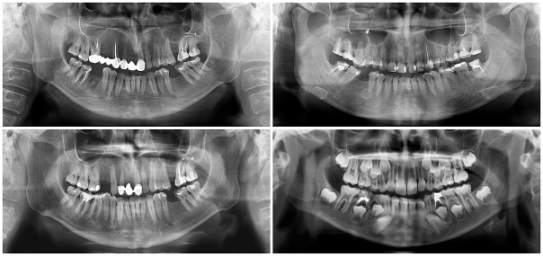 A panoramic dental x-ray digital image of upper and lower jaw. Black ad white radiograph scanning of maxilla and mandible. Four focal plane tomography to thirty-year-old woman, forty-year-old man, child aged seven years.