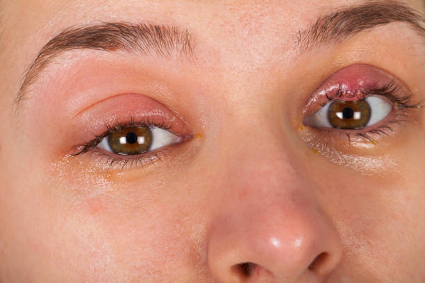 Upper eyelid infection - chalazion stock photo
