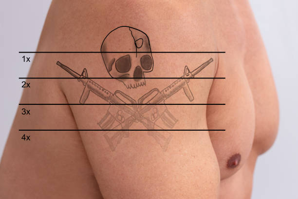 Shirtless Man Showing Before And After Laser Tattoo Removal Treatment On Arms