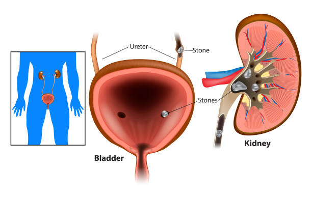 illustrazioni stock, clip art, cartoni animati e icone di tendenza di malattia dei calcoli renali - kidney stone