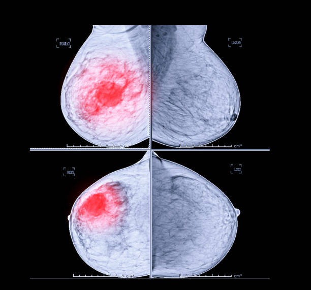 X-ray Digital Mammogram both side CC view and MLO . mammography or breast scan for Breast cancer showing BI-RADS 4 Suspicious. X-ray Digital Mammogram both side CC view and MLO . mammography or breast scan for Breast cancer showing BI-RADS 4 Suspicious. tumor photos stock pictures, royalty-free photos & images