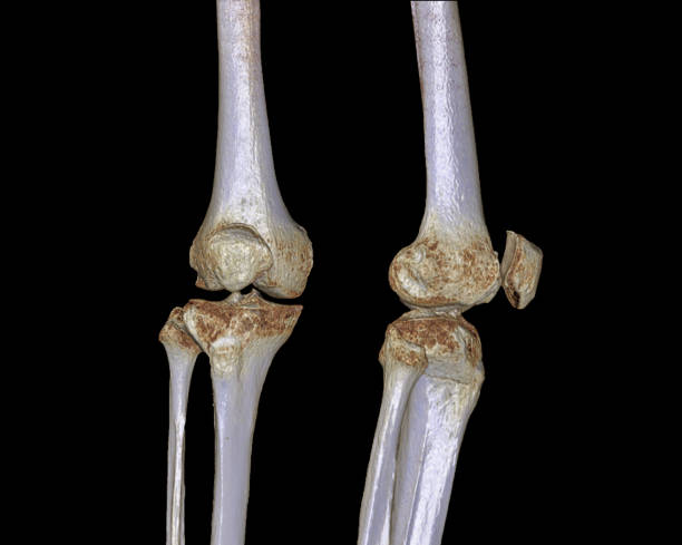 obraz renderowania 3d prawego kolana izolowane na czarnym tle z tomografii komputerowej ct scan ap i widok boczny. ścieżka przycinająca. - lateral condyle zdjęcia i obrazy z banku zdjęć