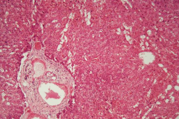 human levervävnad med amyloidos under ett mikroskop. - amyloid bildbanksfoton och bilder