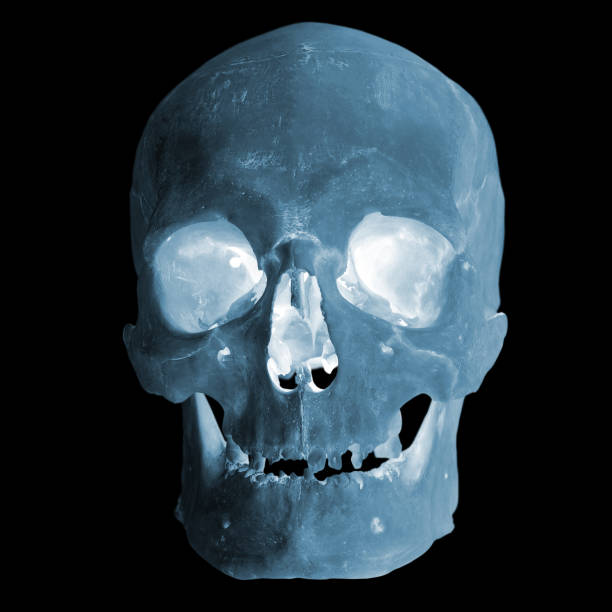 istock X-ray image of a human skull, imitation. Isolated on black. Smiling skull. 1097448136