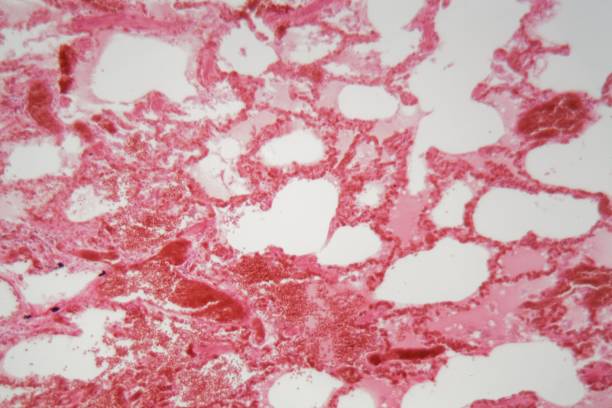 istock Human lung tissue with pneumonia infection caused by Viral pneumonia under a microscope. 1097452142