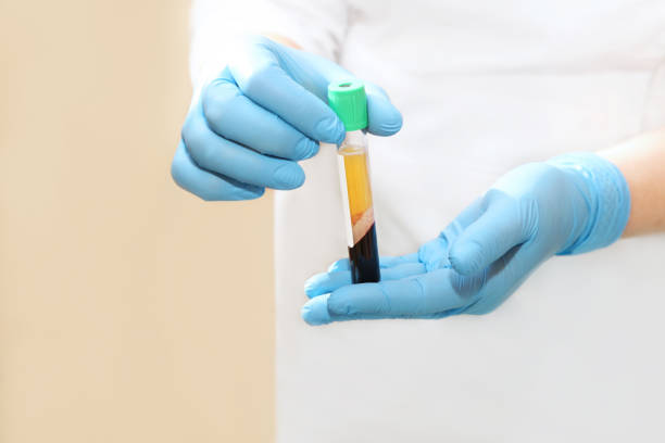 Medical test tube with blood plasma in hands for PRP therapy, after centrifuge apparatus Medical test tube with blood plasma in hands for PRP therapy, after centrifuge apparatus blood plasma stock pictures, royalty-free photos & images