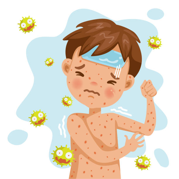 Rubella Rash fever. German measles. A sick boy with fever and red rash. Gel reduces heat. Feeling bad when symptoms. Cartoons of rubella virus. Cause of infection. measles illustrations stock illustrations