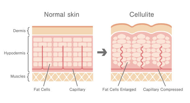 ilustrações de stock, clip art, desenhos animados e ícones de comparative illustration of normal skin and cellulite's skin - fat layer