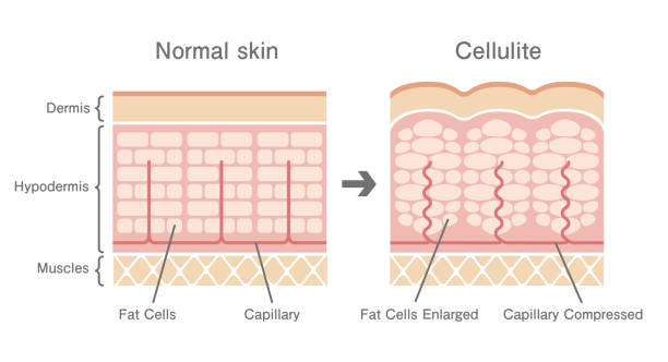 Comparative illustration of normal skin and cellulite's skin Comparative illustration of normal skin and cellulite's skin cellulite stock illustrations