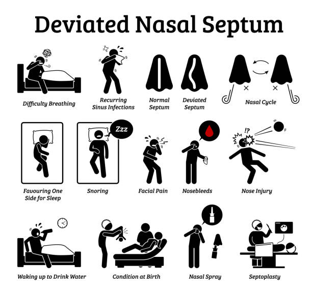 Deviated nasal septum icons. Illustrations depict signs and symptoms of nose problem. Difficulty breathing, sinus infection, snoring, and facial pain. Treatments are nasal spray and septoplasty. septum stock illustrations
