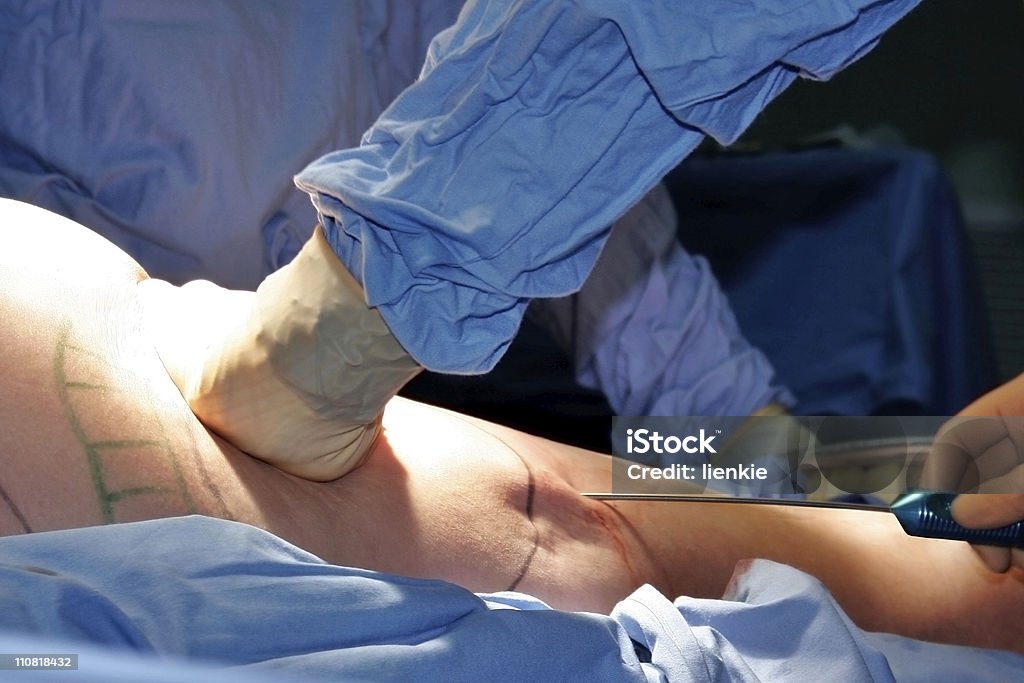 Liposukcja Chirurgia kosmetyczna - Zbiór zdjęć royalty-free (Chirurg)