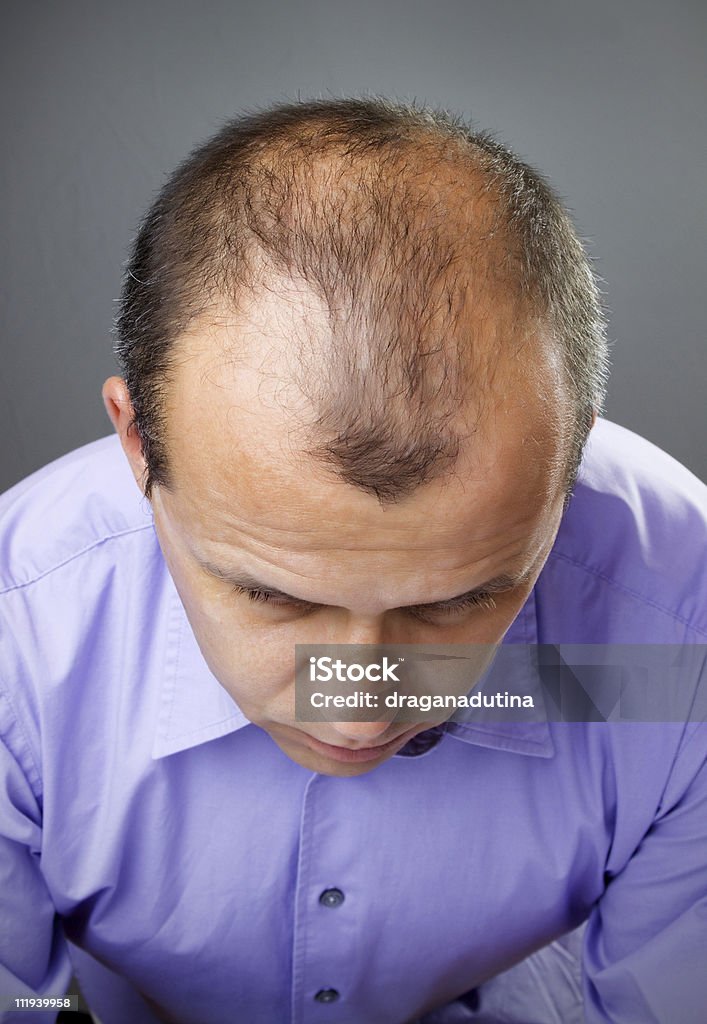 A closeup of a balding man's head Middle aged man with hair loss problem, shot from above Adult Stock Photo