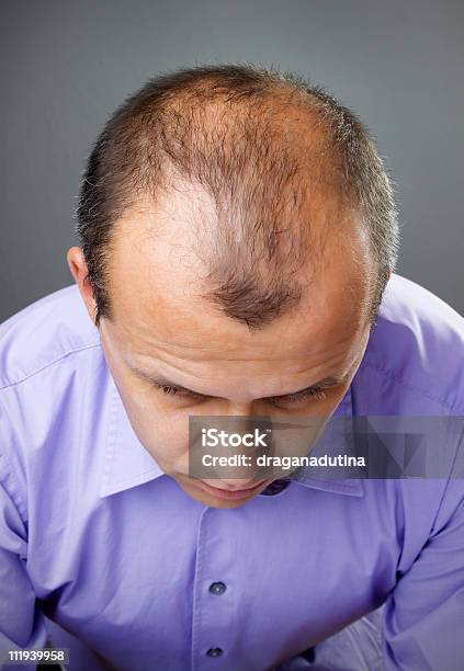 A Closeup Of A Balding Mans Head Stock Photo - Download Image Now - Adult, Adults Only, Balding