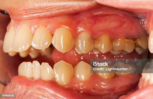 Foto de Dente Humano e mais fotos de stock de Aberto - Aberto, Apodrecer, Bactéria