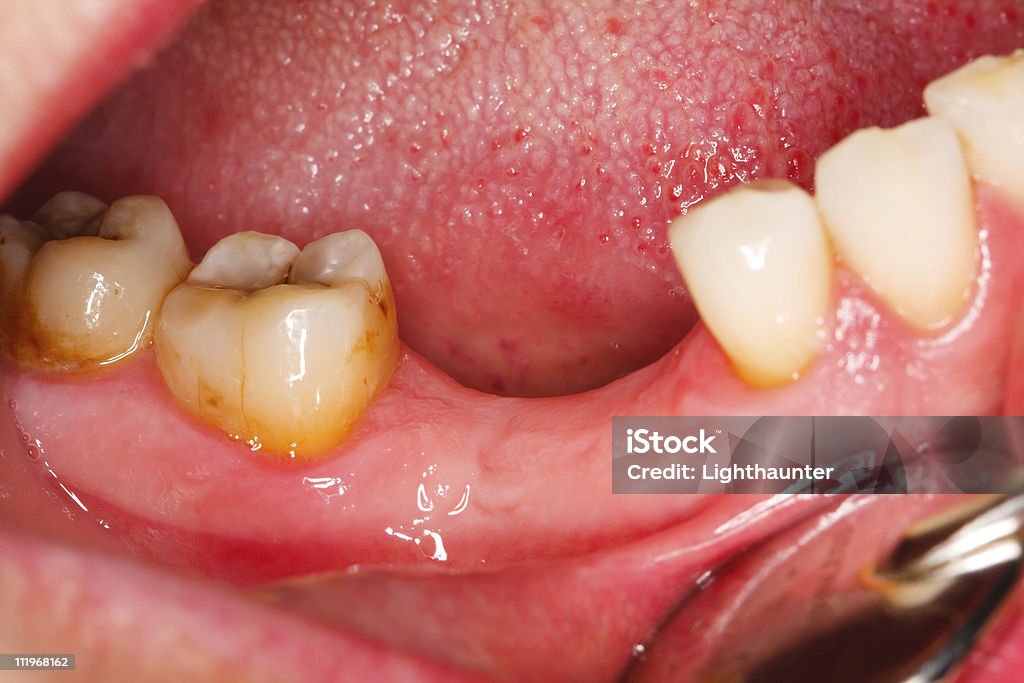 臼歯のタルタルや caries - カラー画像のロイヤリティフリーストックフォト