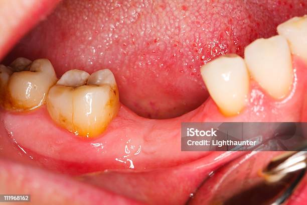 臼歯のタルタルや Caries - カラー画像のストックフォトや画像を多数ご用意 - カラー画像, バクテリア, ヒトの口