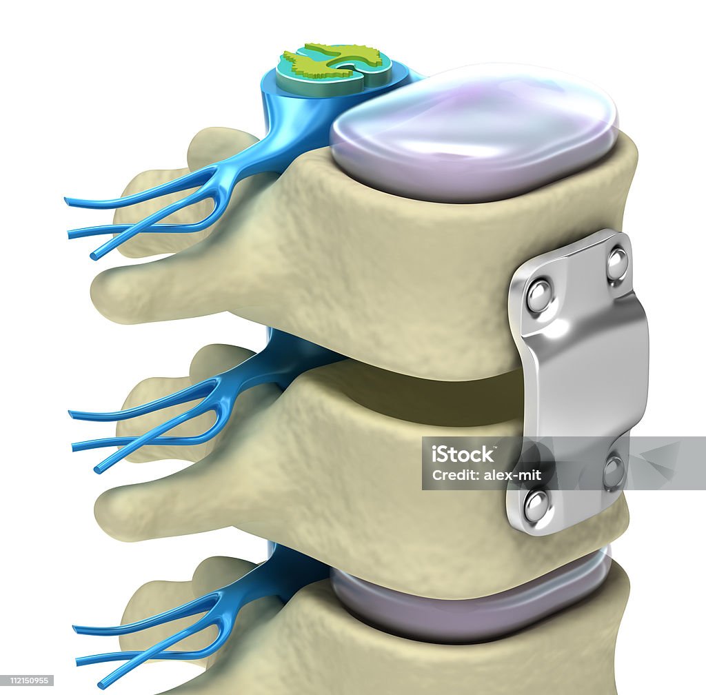 脊髄固定システム - 3Dのロイヤリティフリーストックフォト