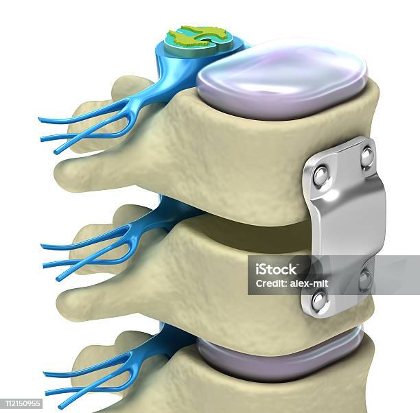 脊髄固定システム - 3Dのストックフォトや画像を多数ご用意 - 3D, X線撮影, イラストレーション