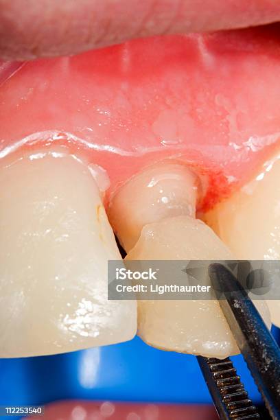 Coroa De Dente Temporário - Fotografias de stock e mais imagens de Coroa Dentária - Coroa Dentária, Dente Humano, Equipamento Dentário