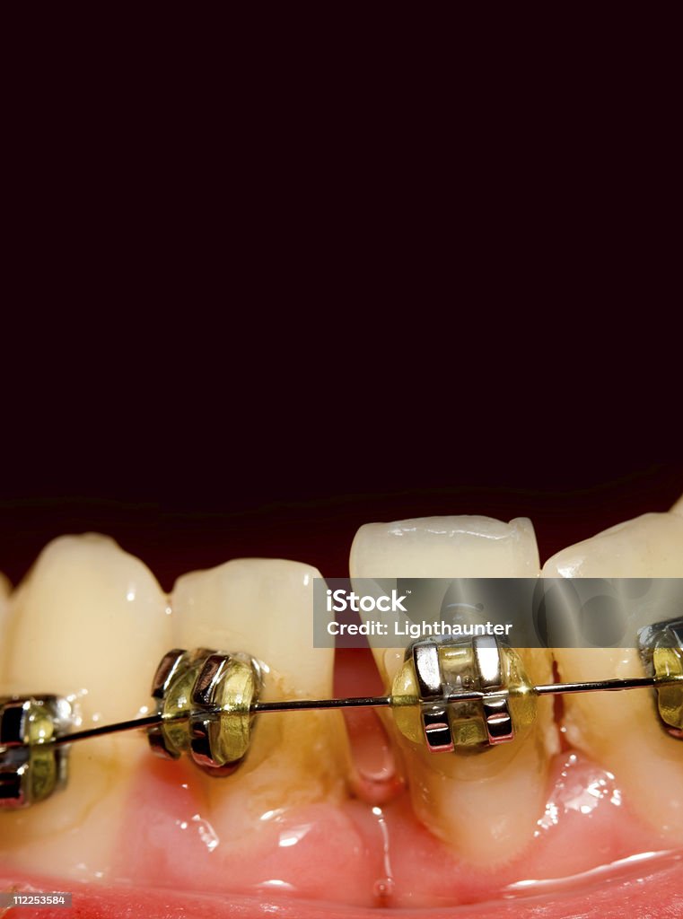 Closing of gap with dental braces  Close-up Stock Photo