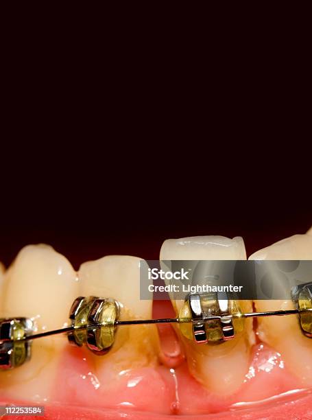 Closing Of Gap With Dental Braces Stock Photo - Download Image Now - Close-up, Color Image, Copy Space