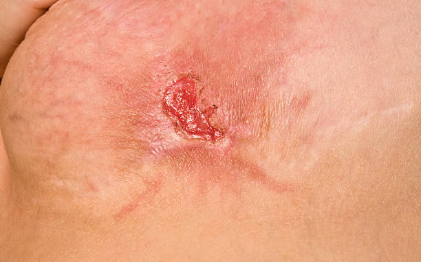 Methicillen Resistant Staphylococcus Aureus  infected wound stock pictures, royalty-free photos & images