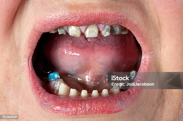 Dentes E De Implantes - Fotografias de stock e mais imagens de Coroa Dentária - Coroa Dentária, Partido, Aberto