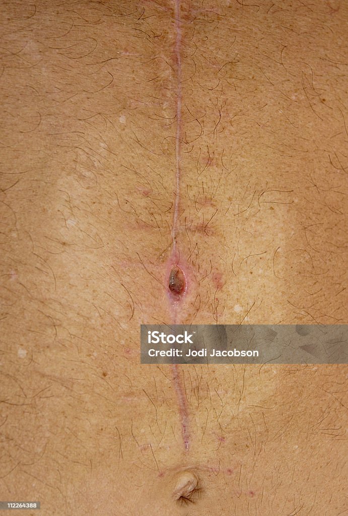 Abdo incision scar site SARM - Photo de Anatomie libre de droits