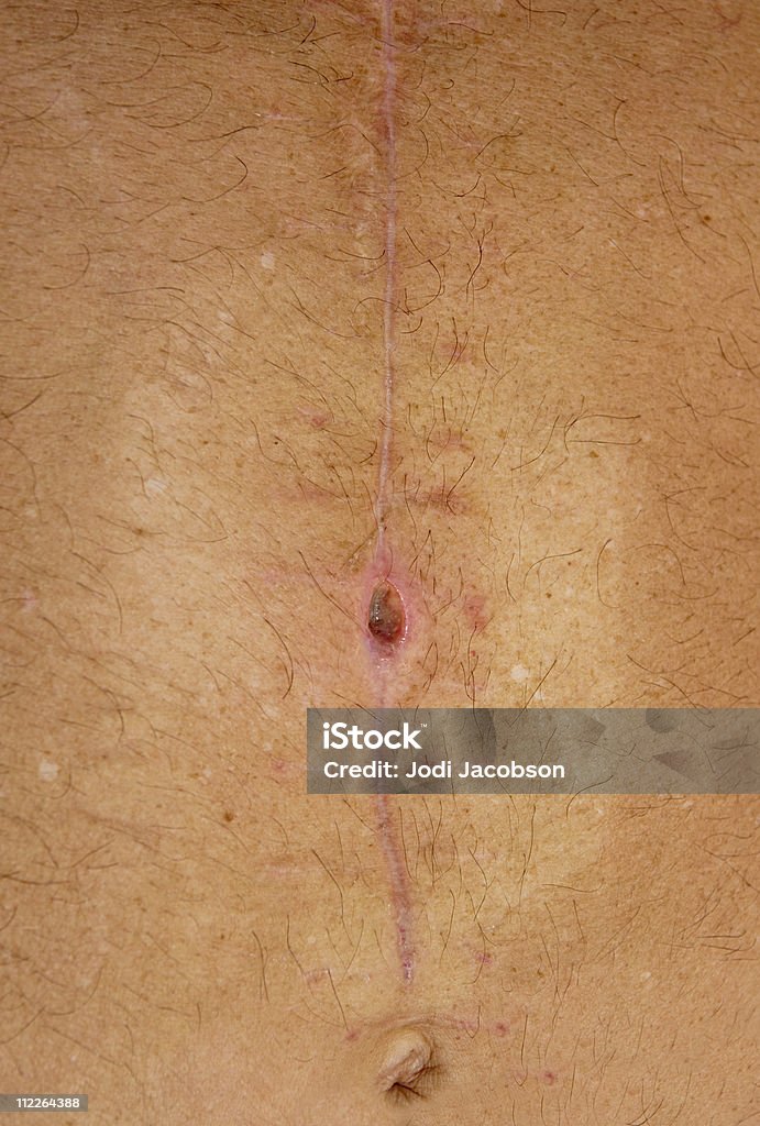 Incisão abdominal Cicatriz local com Staphylococcus Aureus Resistente à Meticilina - Royalty-free Abdómen Humano Foto de stock
