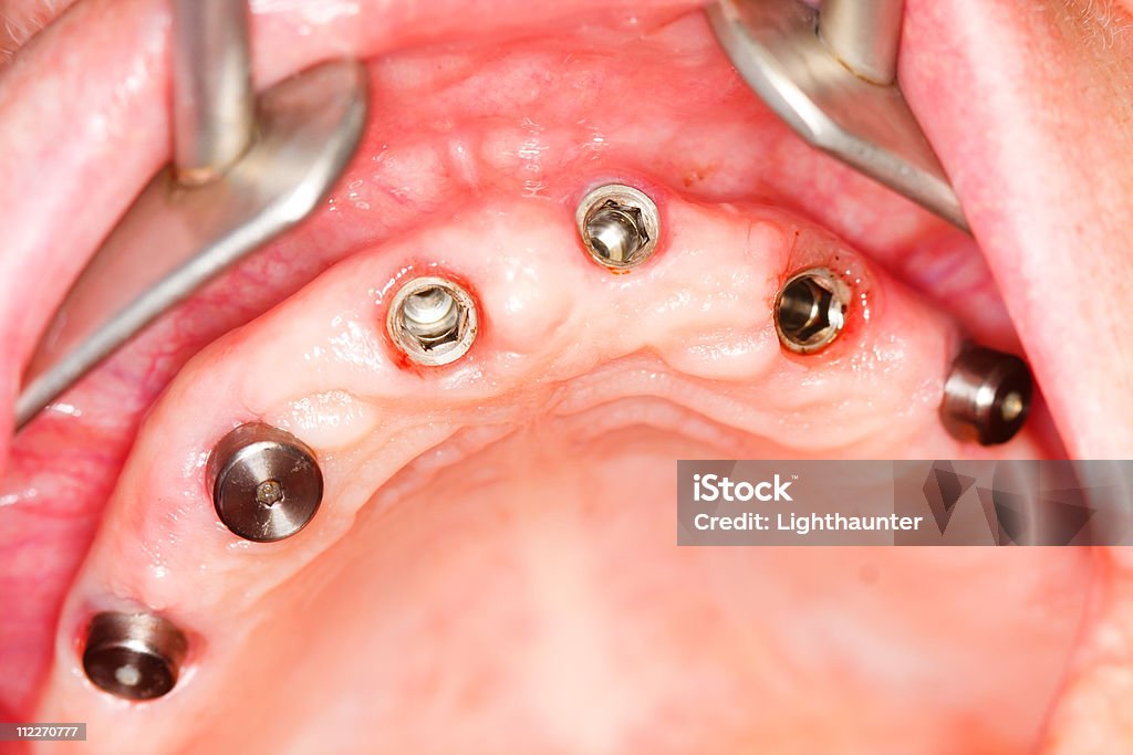 Dental Implantate in Menschlicher Mund - Lizenzfrei Farbbild Stock-Foto