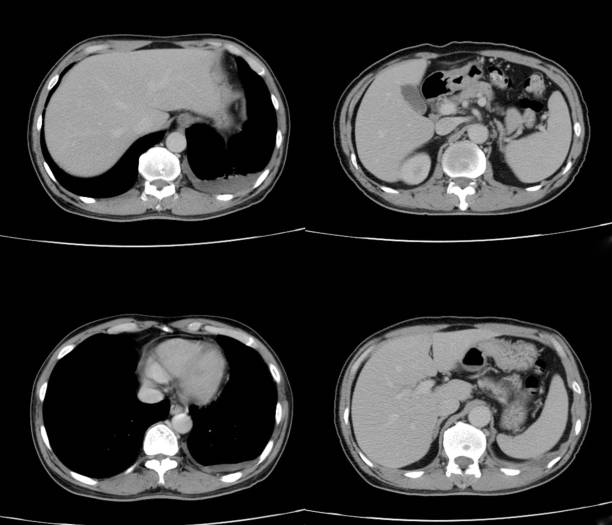 istock Transverse view or axial plain CT chest show Infitrative mass and nodules at upper lobe. 1124283547