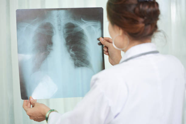 폐 엑스레이 검사 - human lung asthmatic x ray human internal organ 뉴스 사진 이미지