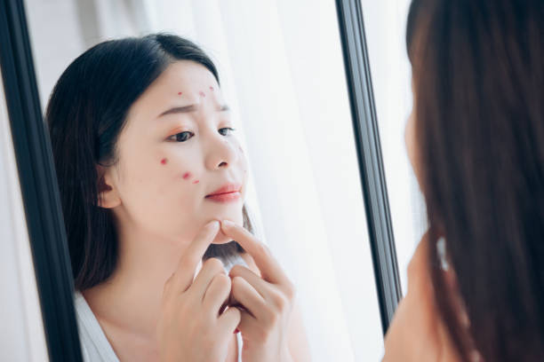 istock Young Asian woman squeeze acne problem face looking at mirror her without Skincare. 1124407839