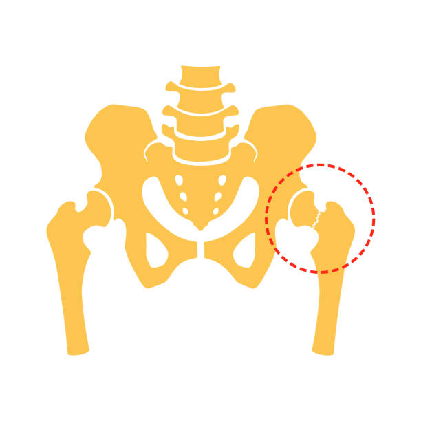 złamanie szyi kości udowej. fragment struktury ludzkiego szkieletu. - biodro stock illustrations